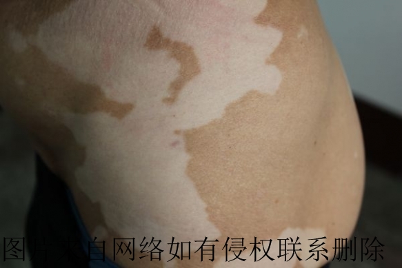 白癜风好转后为什么会复发