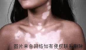 女性白癜风有什么病因