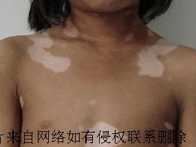 究竟治疗白癜风才能治的好