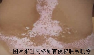 局限型白癜风能治好吗